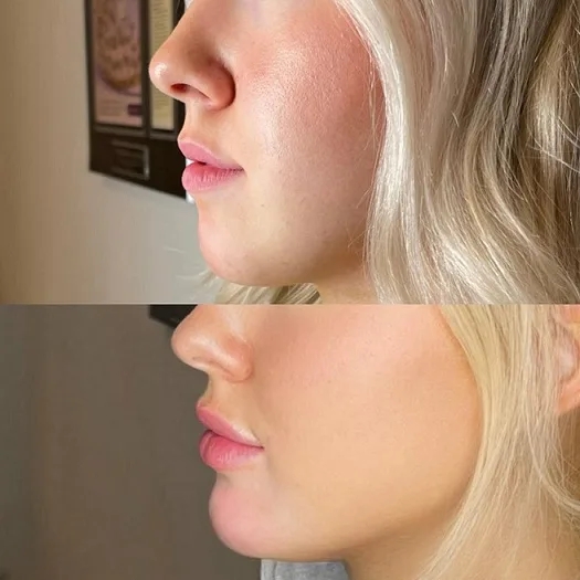 Experience Stunning Chin Contouring with Chin Fillers at the Best Aesthetic Clinics in dubai